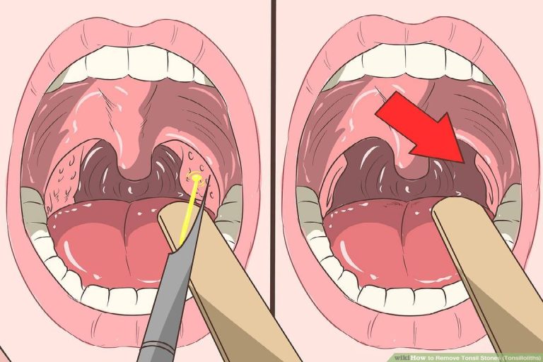 What is Tonsil stones? Definition, Tonsil Infections, Causes