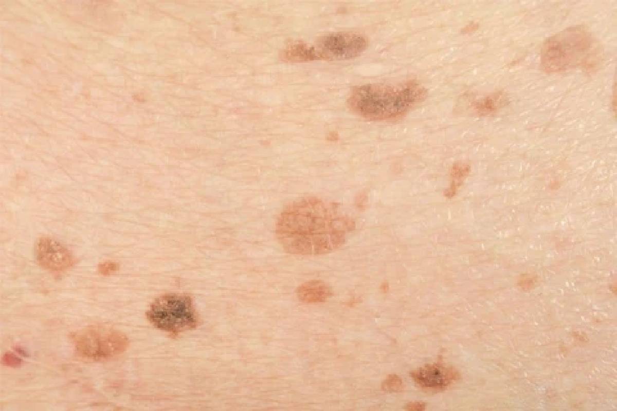 Dark Spots On The Skin Causes Diseases Treatment And More