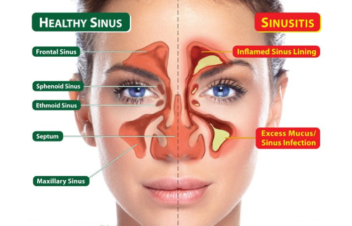 What is Sinus Infection? – Definition, Symptoms, Treatment