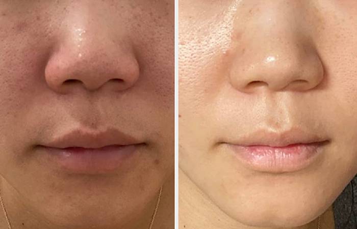 accutane nose pores 