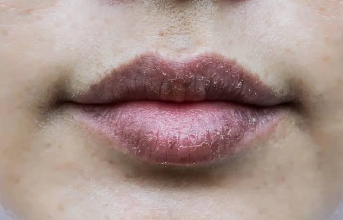 does accutane make your lips bigger
