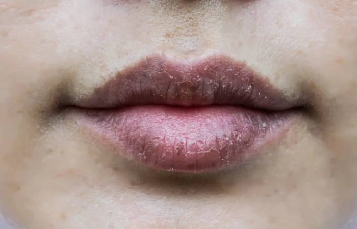 does accutane make your lips bigger 