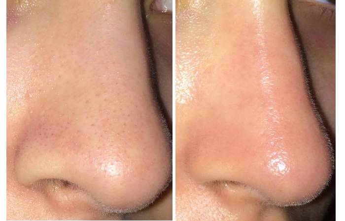 accutane nose before and after reddit 