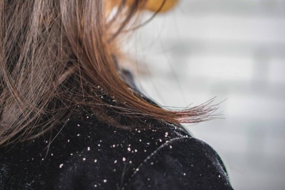 Dandruff write for us, Contribute And Submit post