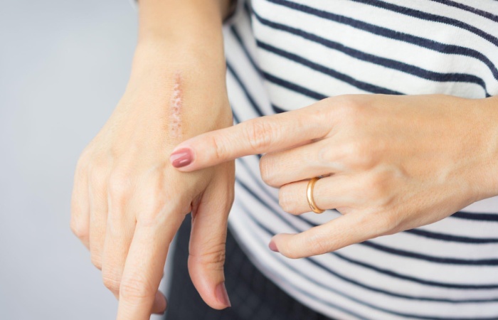 SSSS [Staphylococcal scalded skin syndrome]  Write for us
