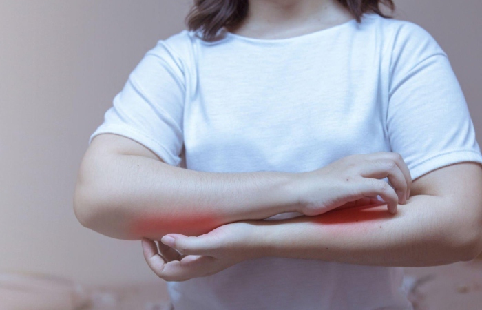 Psoriasis Write for Us