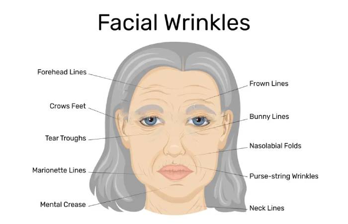 How to Get Rid of Deep Forehead Wrinkles?