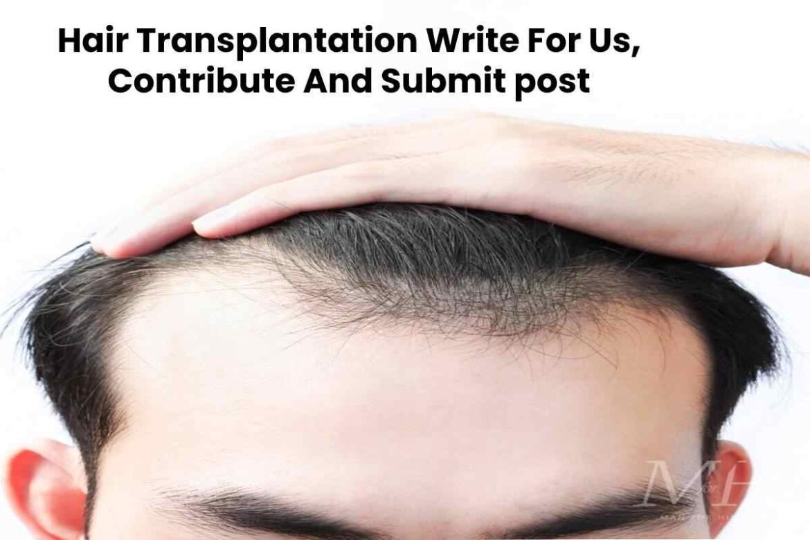 Hair Transplantation Write For Us