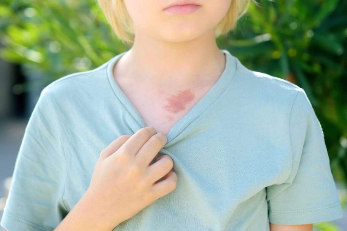 SSSS [Staphylococcal scalded skin syndrome]  Write for us